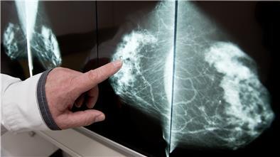Beim Mammographie-Screening werden schon frühzeitig Veränderungen in der Brust, wie hier eine gutartige Fettzellen-Verkalkung, erkannt.