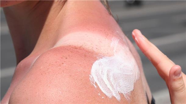 Streifen auf der Haut: besser nicht Besser vorher eincremen und sich schützen: Sonnenbrand schädigt die Haut.
