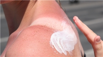 Besser vorher eincremen und sich schützen: Sonnenbrand schädigt die Haut.
