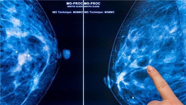 Brustkrebs stellt mit etwa 75.000 Neuerkrankungen jährlich die häufigste Krebserkrankung bei Frauen in Deutschland dar. (Archivbild)