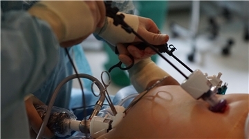 Der minimalinvasive Eingriff: Mit einem Trokar (links), einem Arbeitskanal, wird im Nabelbereich ein Zugang zum Bauchraum geschaffen. Hiermit wird Luft in den Bauch geblasen, damit der Chirurg Platz zum Operieren hat. Über zwei weitere Arbeitstrokare (rechts im Bild) kann der Operateur Miniinstrumente in den Unter- oder Oberbauch einführen.
