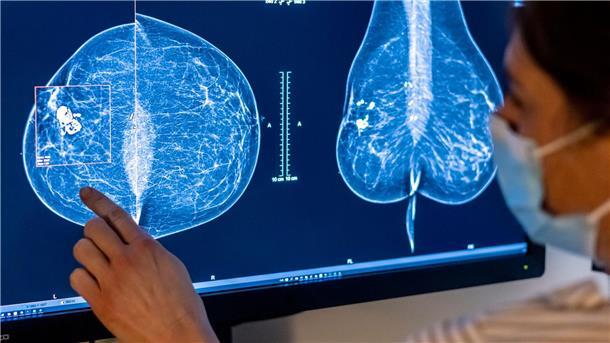 Die Möglichkeiten zur Mammographie für die Früherkennung von Brustkrebs soll ausgeweitet werden.