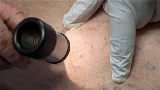 Die Zahl der Krankenhausbehandlungen von Hautkrebs stieg enorm an. (Symbolbild)