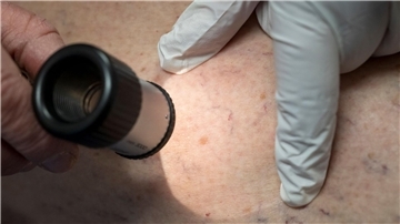 Die Zahl der Krankenhausbehandlungen von Hautkrebs stieg enorm an. (Symbolbild)
