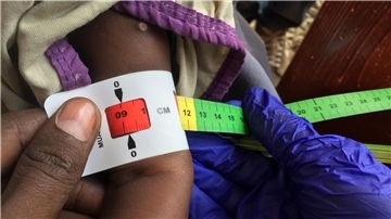 Ein Arzt misst im Sudan den Armumfang eines schwer unterernährten Babys (Archivbild)