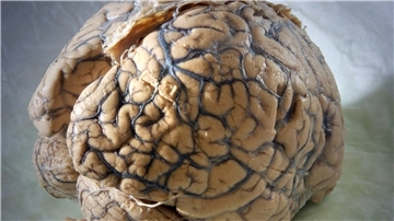 Ein Gehirn des Menschen in einem Labor der Klinik für Neurologie am Universitätsklinikum Jena.