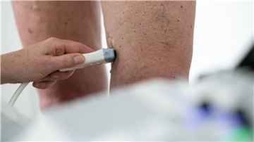 Eine ausführliche Ultraschalluntersuchung spielt eine große Rolle bei der Diagnose von Krampfadern.