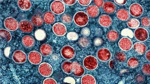 Affenpocken-Ausbruch bleibt Gesundheitsnotstand  Eine eingefärbte Mikroskopaufnahme von Mpox-Partikeln (rot) in einer infizierten Zelle (blau), die im Labor kultiviert wurde.