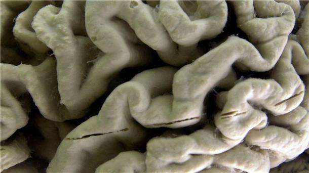 US-Arzneibehörde vergibt Zulassung für Alzheimer-Medikament Eine Nahaufnahme eines menschlichen Gehirns, das von der Alzheimer-Krankheit betroffen ist, ausgestellt im Museum für Neuroanatomie an der University at Buffalo.