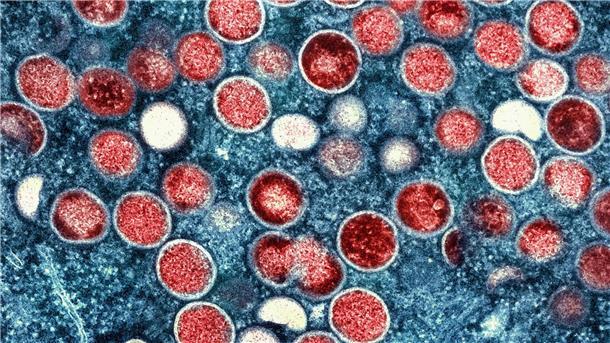 Studie: Ursprung des Mpox-Ausbruchs liegt länger zurück  Forschende haben Gen-Veränderungen des Mpox-Erregers näher untersucht.