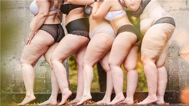 Verbreitet und oft unerkannt: Schweres Leid durch Lipödem Frauen mit Lipödem-Erkrankung. Betroffene kämpfen für eine Ent-Stigmatisierung der Krankheit und fordern mehr kompetente Ärzte.