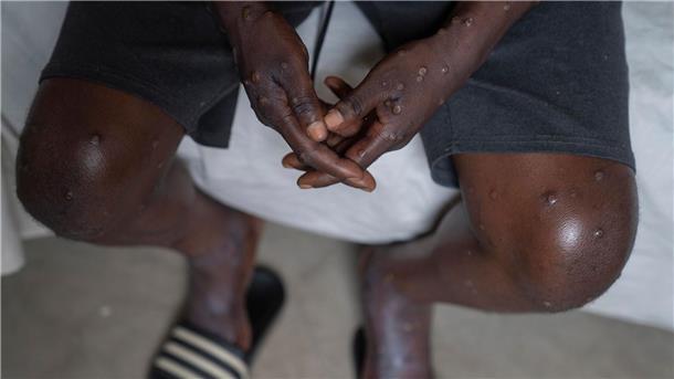 Mehrere Mpox-Ausbrüche in Afrika und eine neue womöglich gefährliche Variante bedrohen die öffentliche Gesundheit weltweit. (Archivbild)