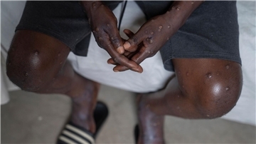 Mehrere Mpox-Ausbrüche in Afrika und eine neue womöglich gefährliche Variante bedrohen die öffentliche Gesundheit weltweit. (Archivbild)