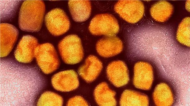 Das Virus ist noch da: Nach langer Ruhe wieder Mpox  Nach langer Ruhe sind in Deutschland wieder einzelne Infektionen mit dem Virus bestätigt worden.