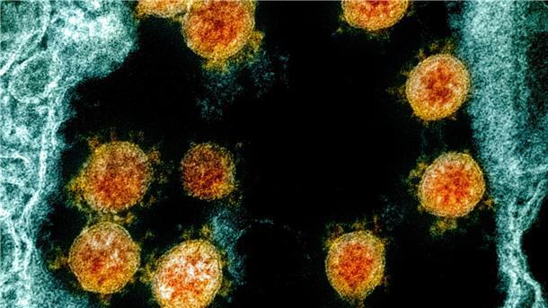 613 Tage lang Corona: Seltener Infektionsfall vorgestellt Partikel des Coronavirus SARS-CoV-2 wurden für eine elektronenmikroskopische Aufnahme farblich bearbeitet.