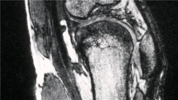 Kassen warnen vor riskanten Hüft- und Kniespritzen Schmerzen im Knie treiben viele Versicherte zum Orthopäden - viele kommen dort mit fragwürdigen Therapien in Kontakt. (Archivbild)